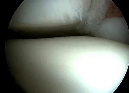 osteoartrita