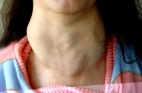 pajzsmirigy