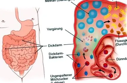 intoleranță intestinul gros