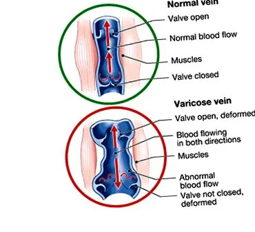hernia