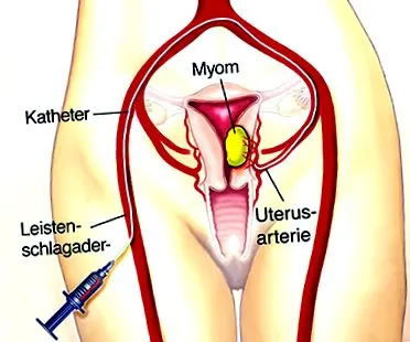 fibromul uterin tratament