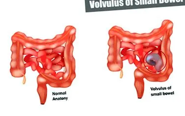 volvulus