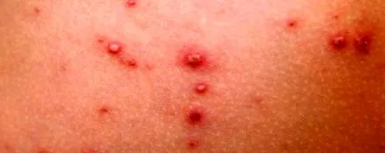 varicella zoster varicella zoster