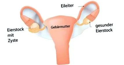 asta ovarian