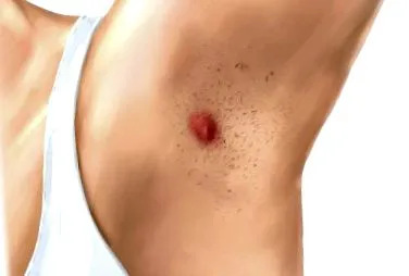 terapia