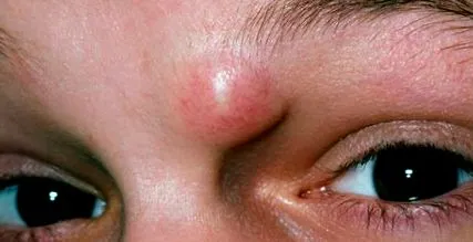 atheroma