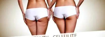 celulită celulită