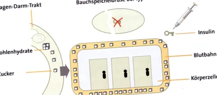 cukorbetegség