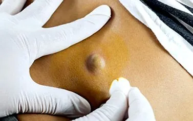 atheroma kezelése