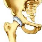 Coxarthrosis csípőízület osteoarthritis