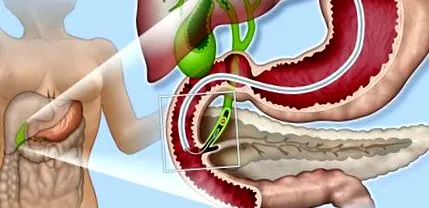 ercp