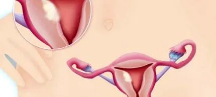 uterin