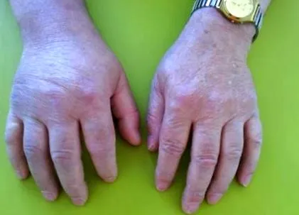 gout