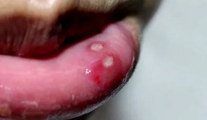 simplex