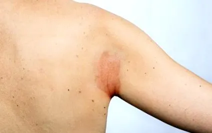 шкіри Екзема