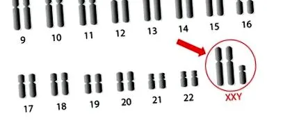 клайнфельтера