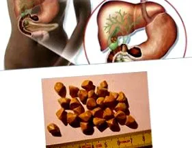 cholecystecomia