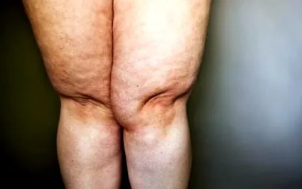 tratați lipedema