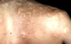 revista farmaciei urticarie