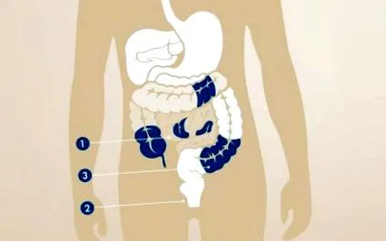 boala Crohn