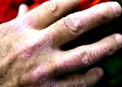 psoriatic