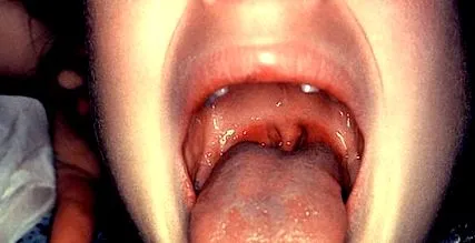 mirigyes