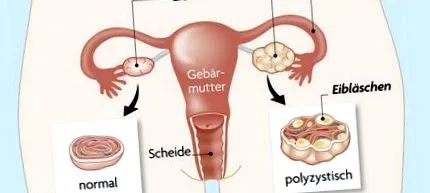 pcos baba