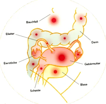 endometrioza deutschland