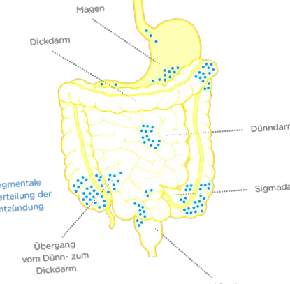 crohn-betegség