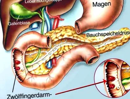 ulcer