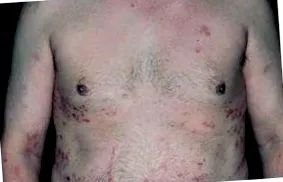 epiderm