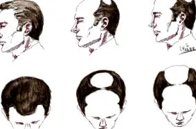alopecia