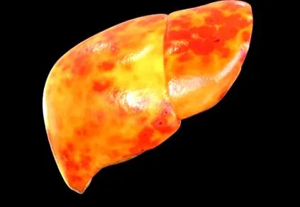 steatosis
