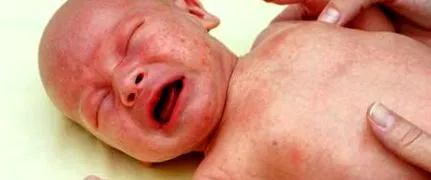 Herpesvirus hominis