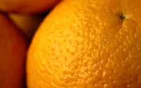 целулит лечение