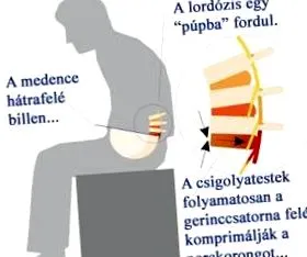 физиотерапевтът дискова херния