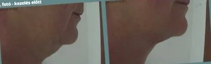 антипаразитарними властивостями чорний перець