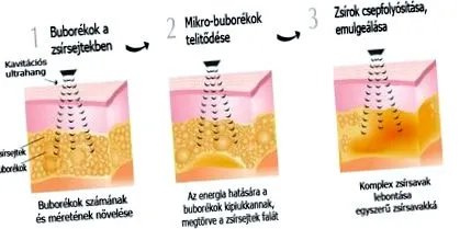 липосукция лечение