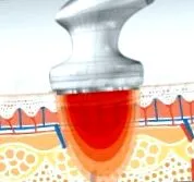 лечение lipozero