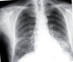 adenocarcinoma