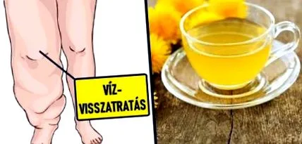 оток лимфедема