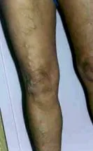 вени радиочестотна