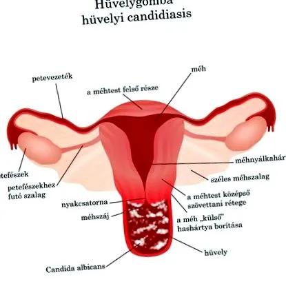 ciuperci vaginale tratamentul