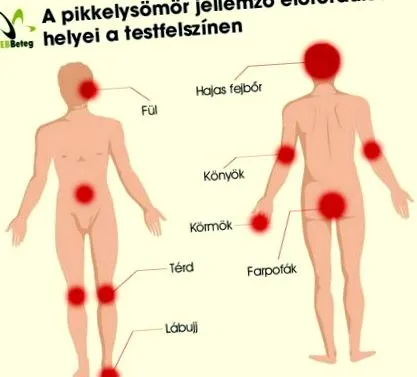 може бъде симптоми