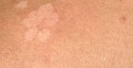 Malassezia furfur симптоми