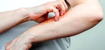 грижа кожата лечение псориазис