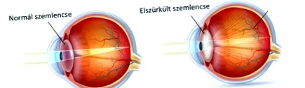 катаракта лечение