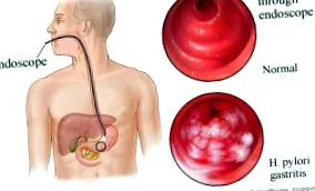 Helicobacter pylori pylori