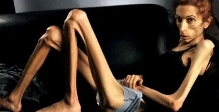булимия anorexia