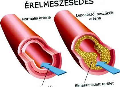 vasele sânge ateroscleroza